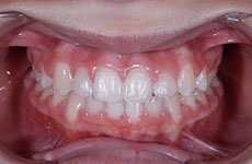 teeth after orthodontic treatment
