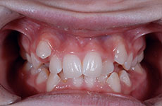 teeth before orthodontics